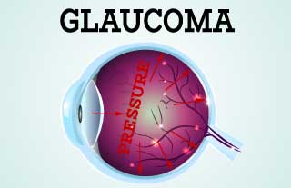 5 common glaucoma tests